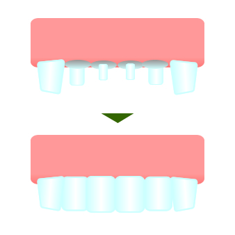 【2週間で笑顔が変わる！】出っ歯治療で白くてキレイな歯並びになる3