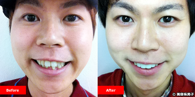 【2週間で笑顔が変わる！】出っ歯治療で白くてキレイな歯並びになる