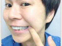 【白い歯】保険適用のハイブリッドセラミック（CADCAM冠・東京）