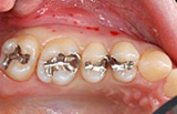 白くて強い歯を『保険適応』で安く手に入れる方法（CAD/CAM）