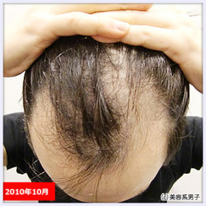 【AGA薄毛治療】ハゲが治るまでの経緯と現在やっている予防方法