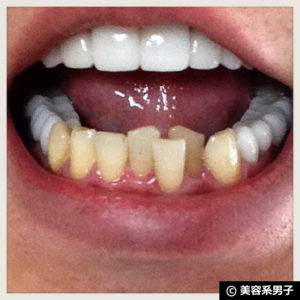 【体験終了】人気ホワイトニング歯磨き粉『歯磨撫子』の効果-口コミ