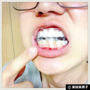 【歯のホワイトニングジェル】ビーグレンデンタル-口コミ【体験開始】