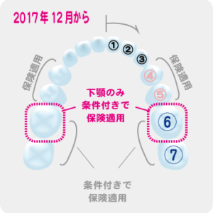 【白い歯】2017年12月より奥歯も保険適用に【CADCAM冠/東京/歯科】