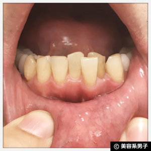 【白い歯】歯医者専用ホワイトニング歯磨き粉「GCルシェロ」効果22