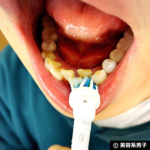 【歯磨き】歯並びが悪いならオーラルBマルチアクションブラシ09