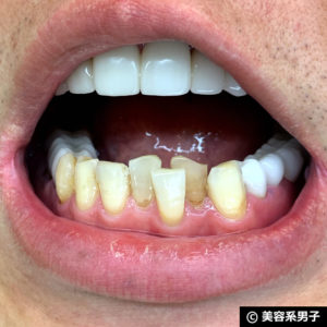 【歯を白く】ホワイトニング歯磨きジェル「キラビアンカ」体験開始04