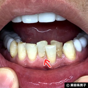 【ホワイトニング歯磨き粉】オーラパール+電動歯ブラシの結果02