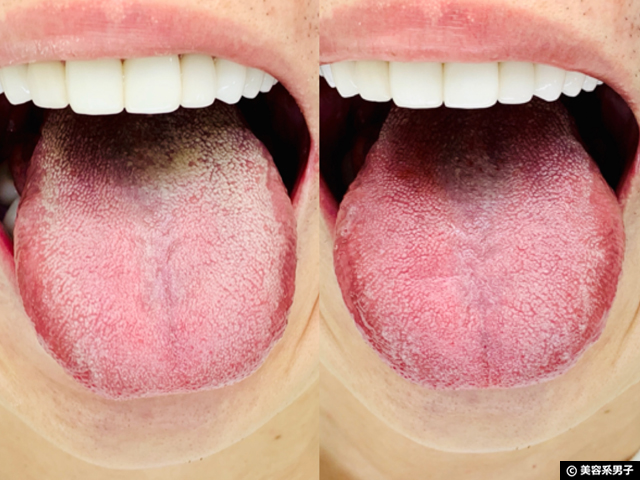 【口臭予防】クラプロックス「舌ブラシ ダブル」おすすめ舌苔除去-05