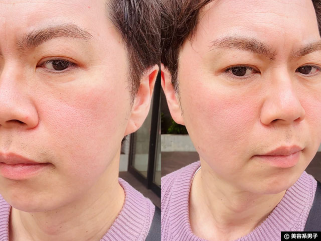 【2Bバイオトリートメント】芸能人も注目のハーブピーリングを体験！ケミカルとの違いや効果、リアルな経過をレポート-04