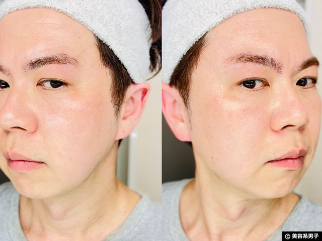 【2Bバイオトリートメント】芸能人も注目のハーブピーリングを体験！ケミカルとの違いや効果、リアルな経過をレポート-05