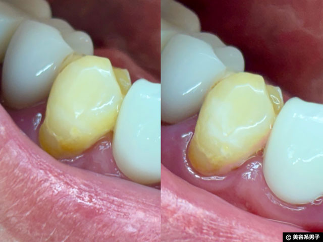 【TikTokで爆売れ】歯は白くなる？CEELIKE nHAP-PRO ホワイトニングストリップを検証-01