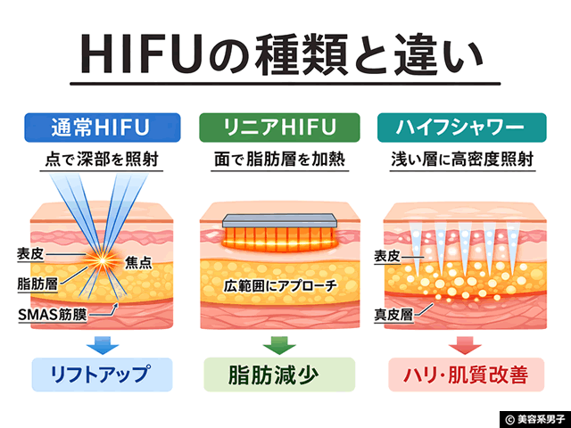 【体験レポ】切らない「たるみ」治療 HIFU（ハイフ）3種打ちしてきた｜麹町皮ふ科・形成外科クリニック-03