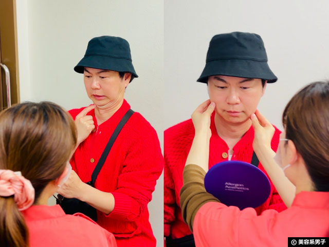 【体験レポ】切らない「たるみ」治療 HIFU（ハイフ）3種打ちしてきた｜麹町皮ふ科・形成外科クリニック-04