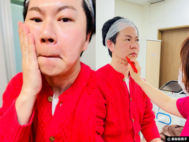 【体験レポ】切らない「たるみ」治療 HIFU（ハイフ）3種打ちしてきた｜麹町皮ふ科・形成外科クリニック-05