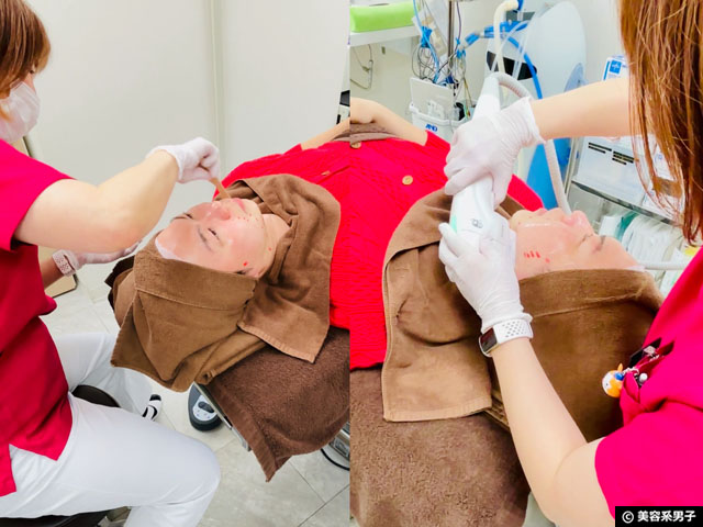 【体験レポ】切らない「たるみ」治療 HIFU（ハイフ）3種打ちしてきた｜麹町皮ふ科・形成外科クリニック-06