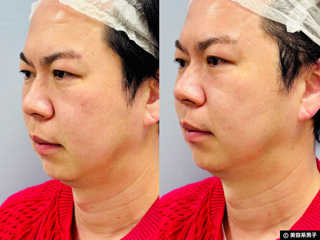 【体験レポ】切らない「たるみ」治療 HIFU（ハイフ）3種打ちしてきた｜麹町皮ふ科・形成外科クリニック-07