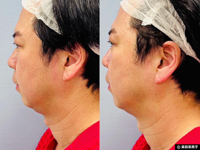 【体験レポ】切らない「たるみ」治療 HIFU（ハイフ）3種打ちしてきた｜麹町皮ふ科・形成外科クリニック-08